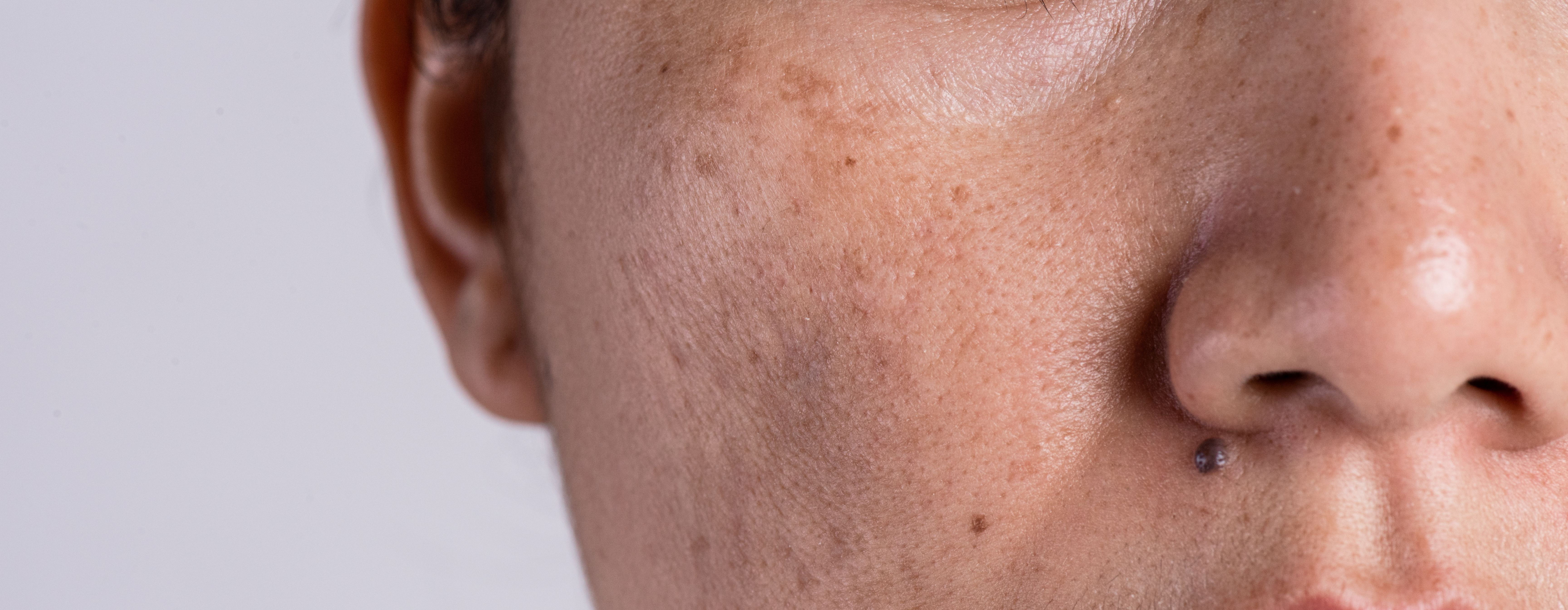 Study Demonstrates Clinical Effectiveness of Polynucleotides HPT® for Asian Skin