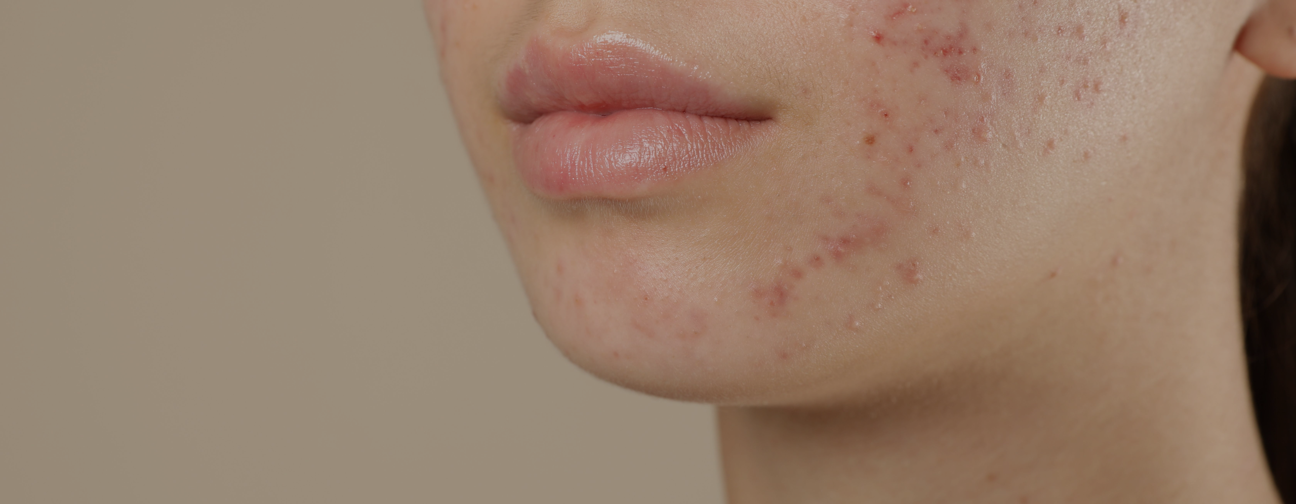 Regeneration Over Suppression: Purasomes and Plinest® for Acne-Prone Skin